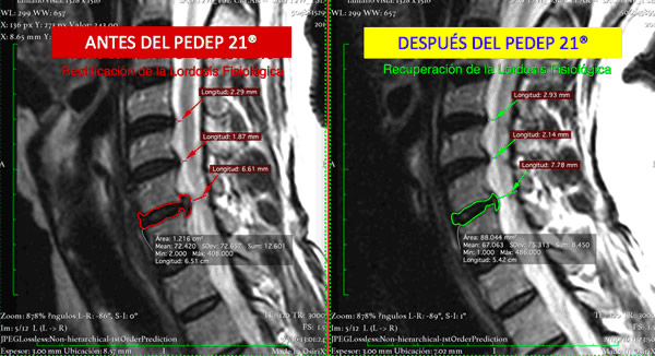 Antes y después del PEDEP 21