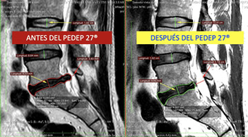 Antes y después del PEDEP 27
