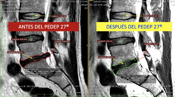 Antes y después del PEDEP 27