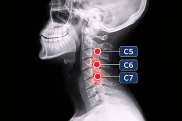 hernia cervical c5-c6 incapacidad