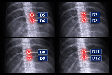 incapacidad por hernia discal dorsal