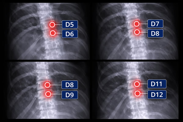 incapacidad por hernia discal dorsal