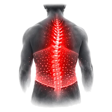Alteración importante de la sensibilidad por debajo de la zona dorsal