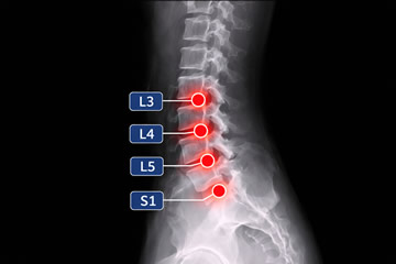 hernia lumbar l3 l4 l5 s1 incapacidad