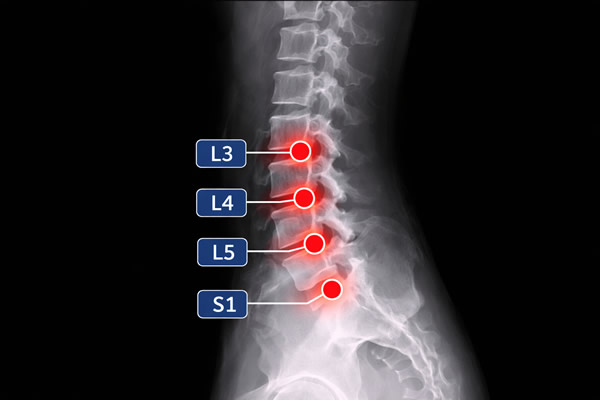 hernia lumbar l3 l4 l5 s1 incapacidad