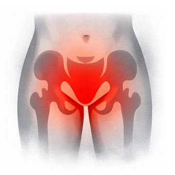 Adormecimiento en periné, genitales o zona de “silla de montar”