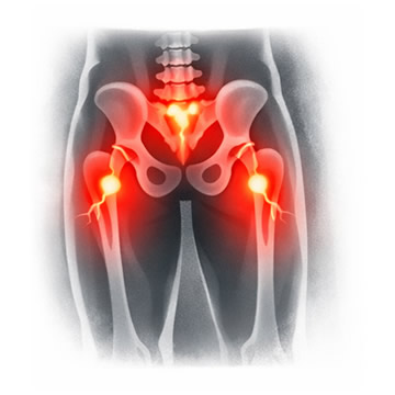 Dolor en ambas piernas junto a alteraciones urinarias o pérdida de sensibilidad perineal